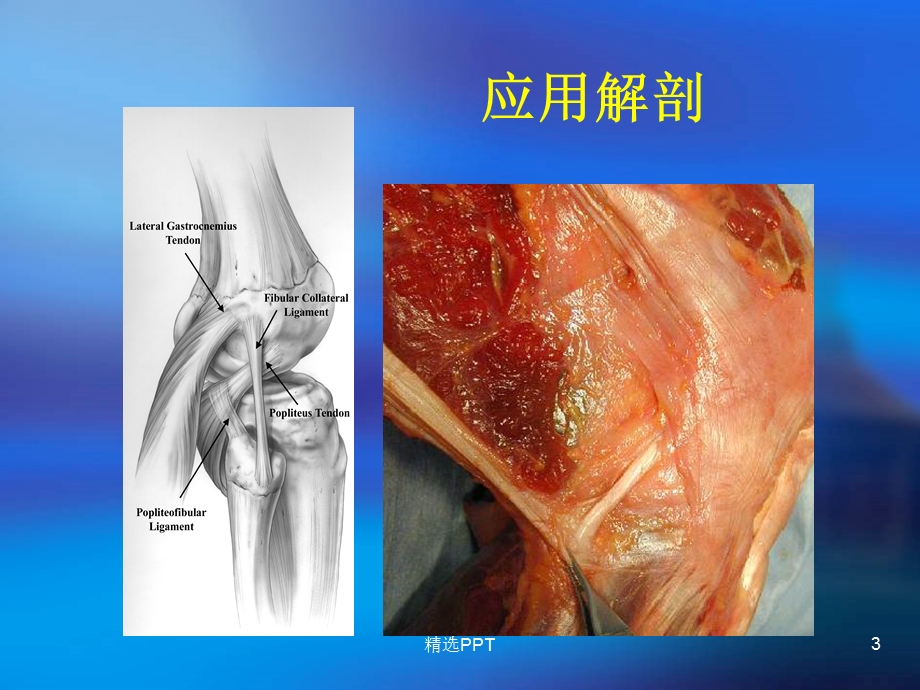 膝关节后外侧韧带结构损伤课件.ppt_第3页