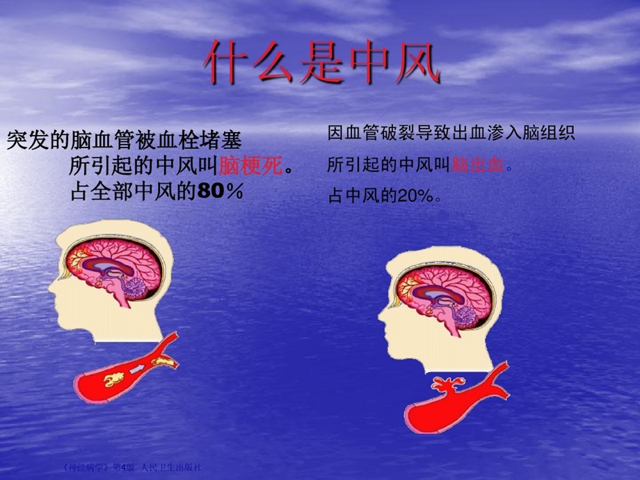 脑卒中护理查房课件.ppt_第2页