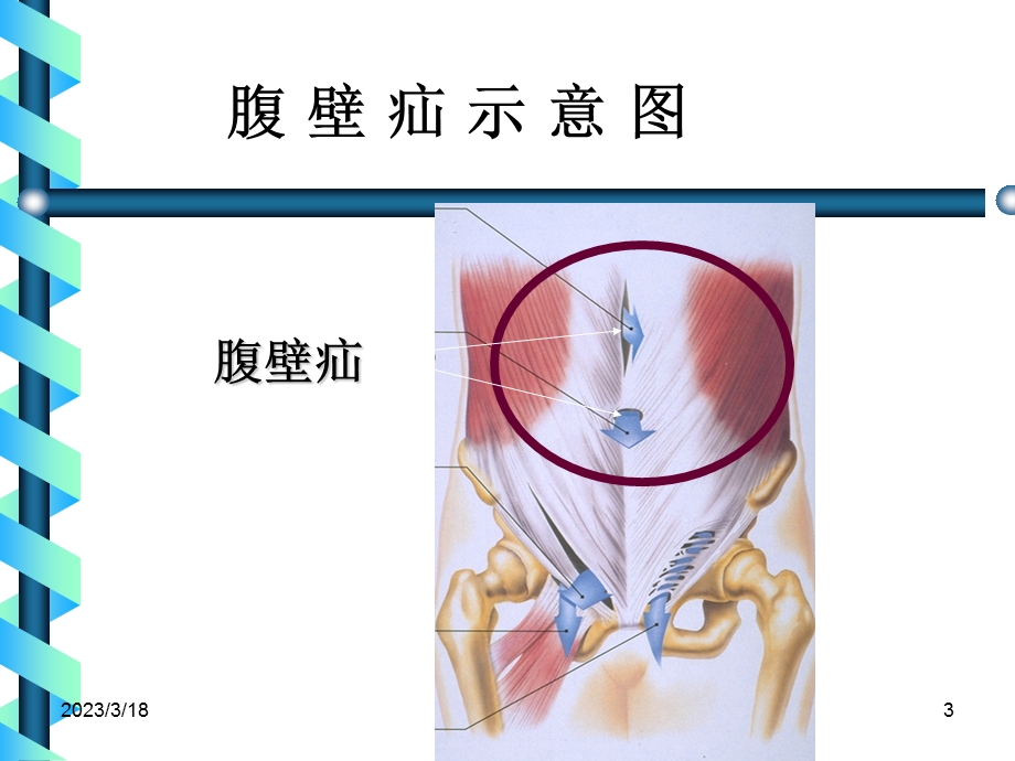 腹股沟疝PPT幻灯片课件.pptx_第3页