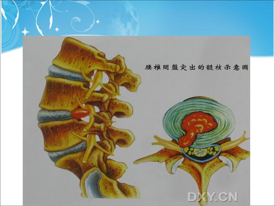 腰椎间盘突出症术后护理_课件.ppt_第3页