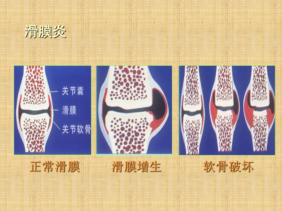 类风湿性关节炎活动性评分及病情缓解评估精编课件.ppt_第3页