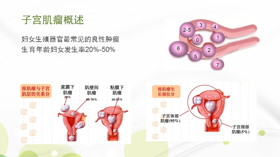 腹腔镜下特殊部位子宫肌瘤剔除术课件.pptx_第2页