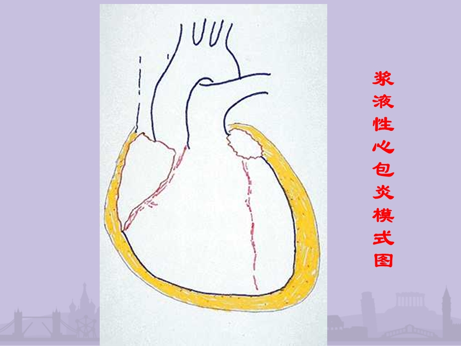 第8版内科学心包积液及心脏压塞课件.ppt_第3页