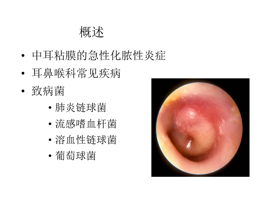 慢性中耳炎伴骨炎课件.ppt_第2页