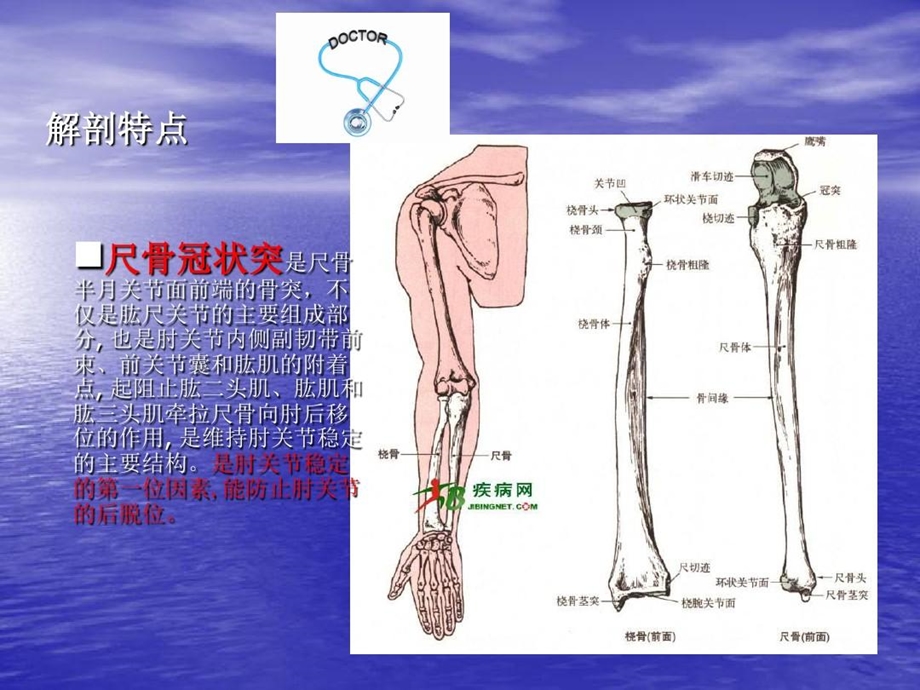 尺骨冠状突骨折护理查房课件.ppt_第3页