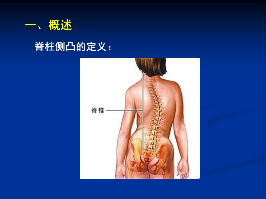 new脊柱侧凸的康复课件.ppt_第3页