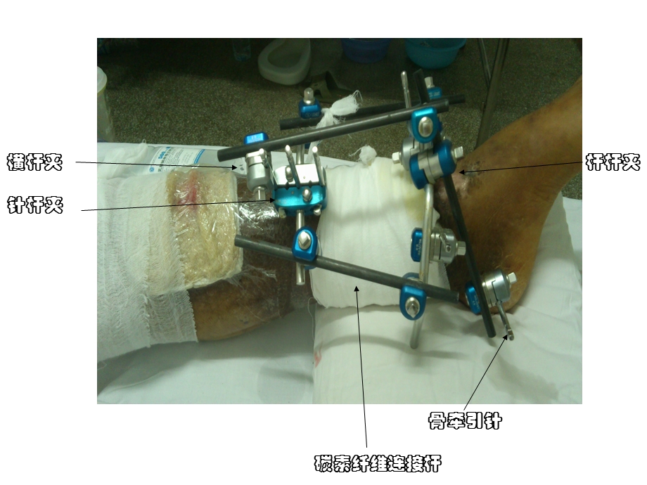 外固定支架护理课件.ppt_第3页