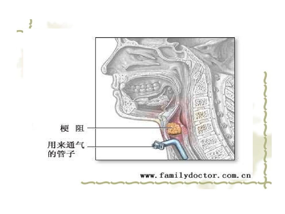 急性喉梗阻护理课件.ppt_第3页