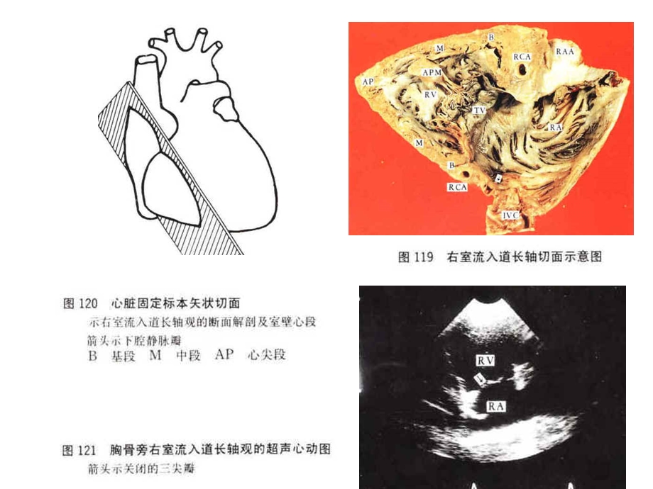 有16幅图心脏超声和心脏断面解剖及室壁心段课件.ppt_第3页