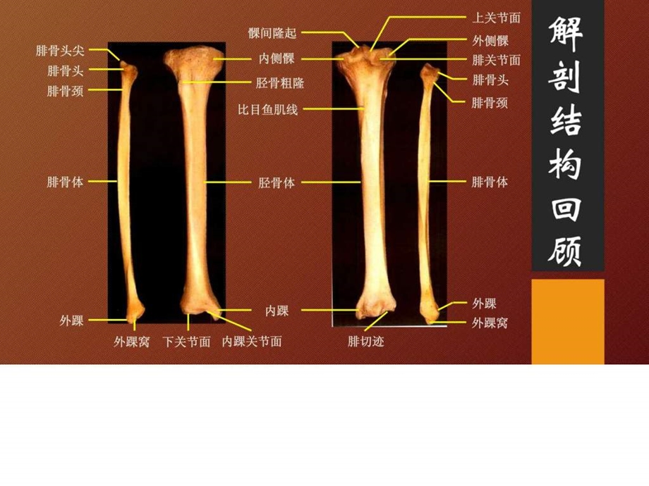 Pilon骨折概述图文课件.ppt_第2页