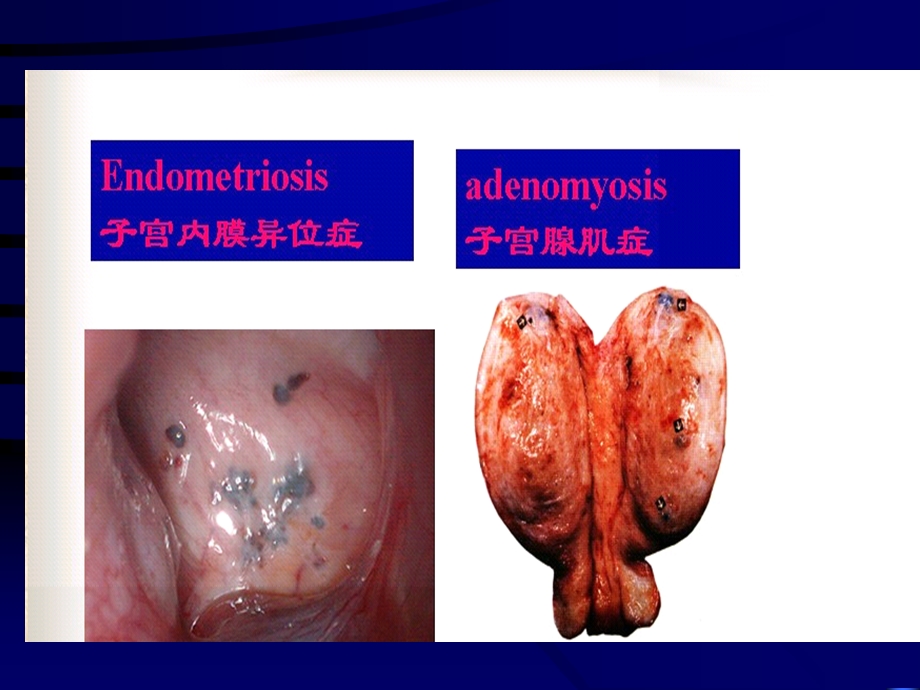 子宫脱垂内膜异位课件.ppt_第2页