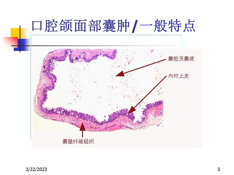 口腔颌面囊肿-课件.ppt_第3页