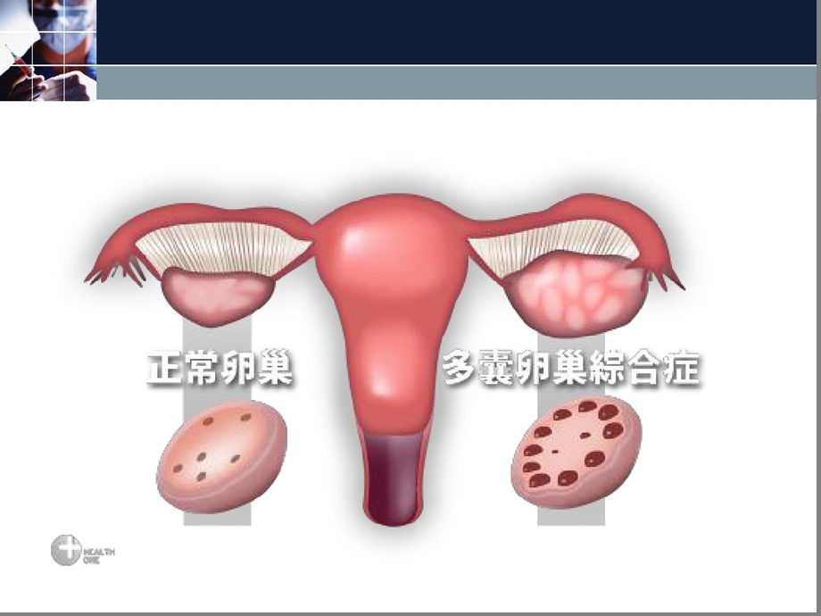 多囊卵巢综合征ppt课件.ppt_第3页