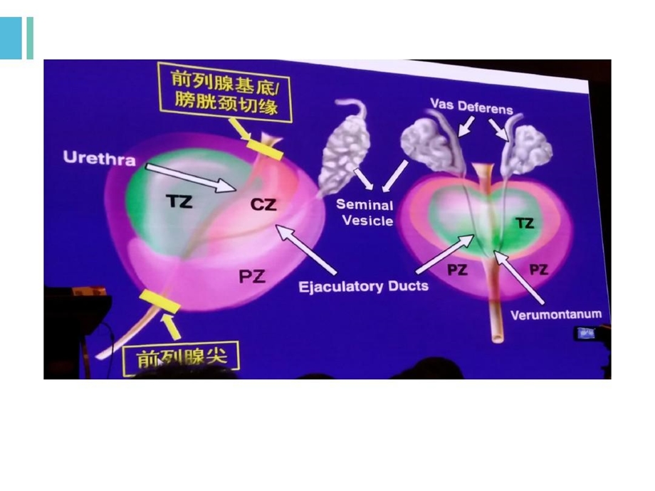 前列腺癌的取材及病理诊断规范课件.ppt_第3页