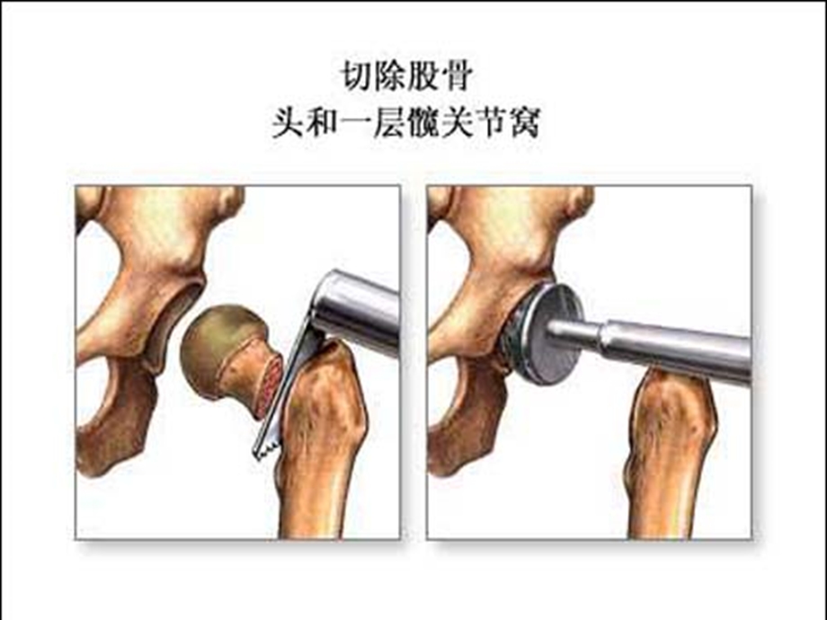 人工全髋关节置换术后功能锻炼课件.ppt_第3页