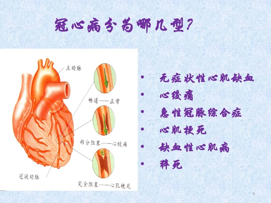 小讲课冠心病课件.ppt_第3页