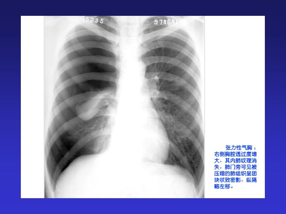 呼吸系统及纵隔多媒体教材课件.ppt_第3页