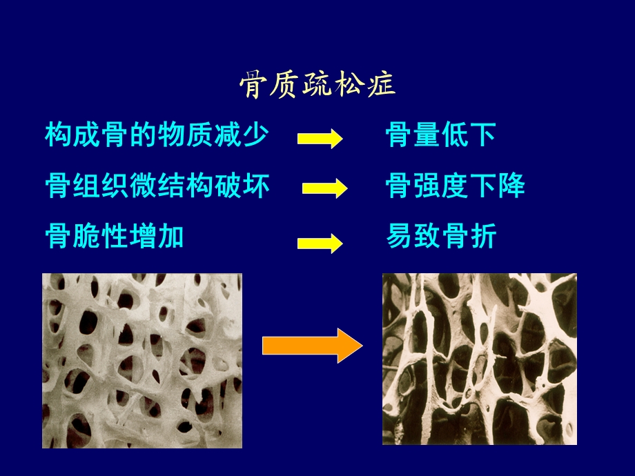 原发性骨质疏松症课件.ppt_第3页