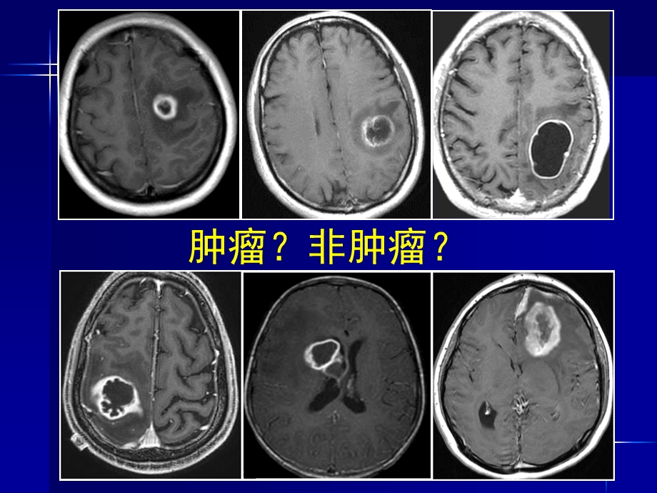 脑内常见环形强化病变影像诊断与鉴别诊断课件.ppt_第2页