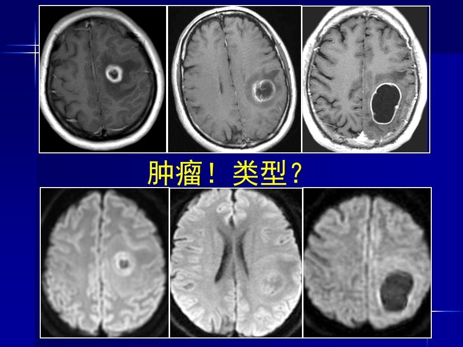 脑内常见环形强化病变影像诊断与鉴别诊断课件.ppt_第3页