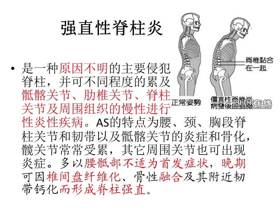 (骨生物力学ppt课件)强直性脊柱炎手术方式之后路经椎弓根椎体截骨术.pptx_第3页