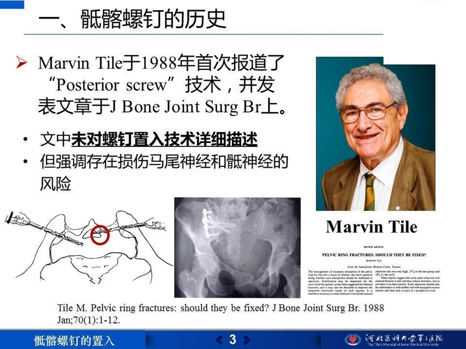 不同骶骨节段置入横行骶髂螺钉的可行性分析及临床应用课件.ppt_第3页