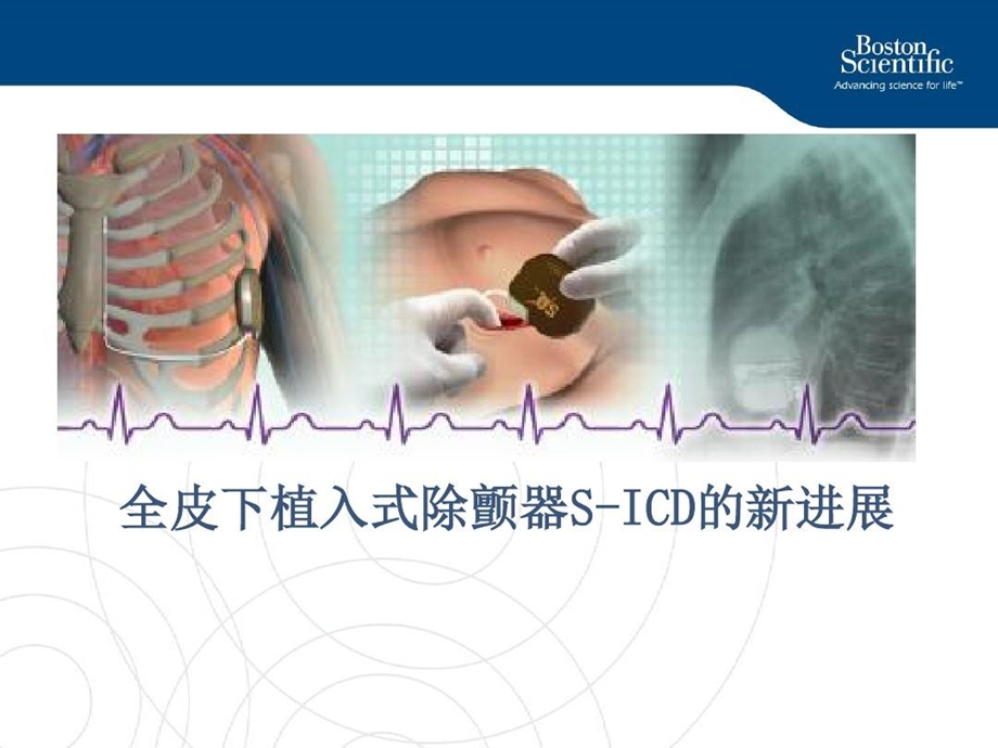 全皮下植入式除颤器SICD的新进展课件.ppt_第2页