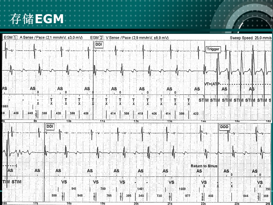 ICD-T波过感知的非侵入性解决方法课件.ppt_第3页