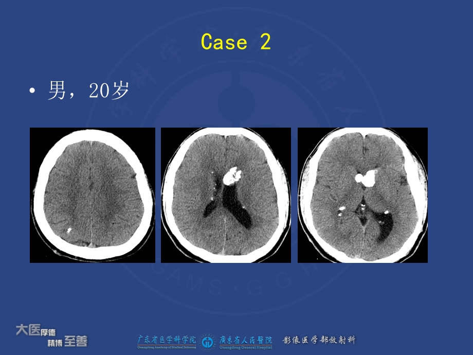 认识结节性硬化综合症在腹部表现课件.ppt_第3页