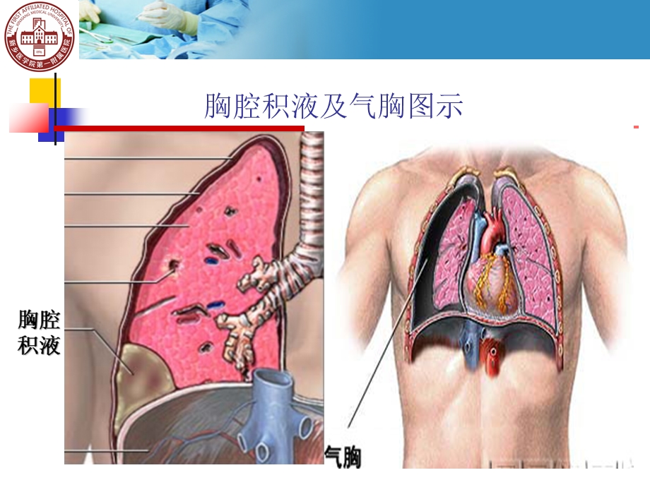 胸腔穿刺ppt课件+技能操作.ppt_第3页