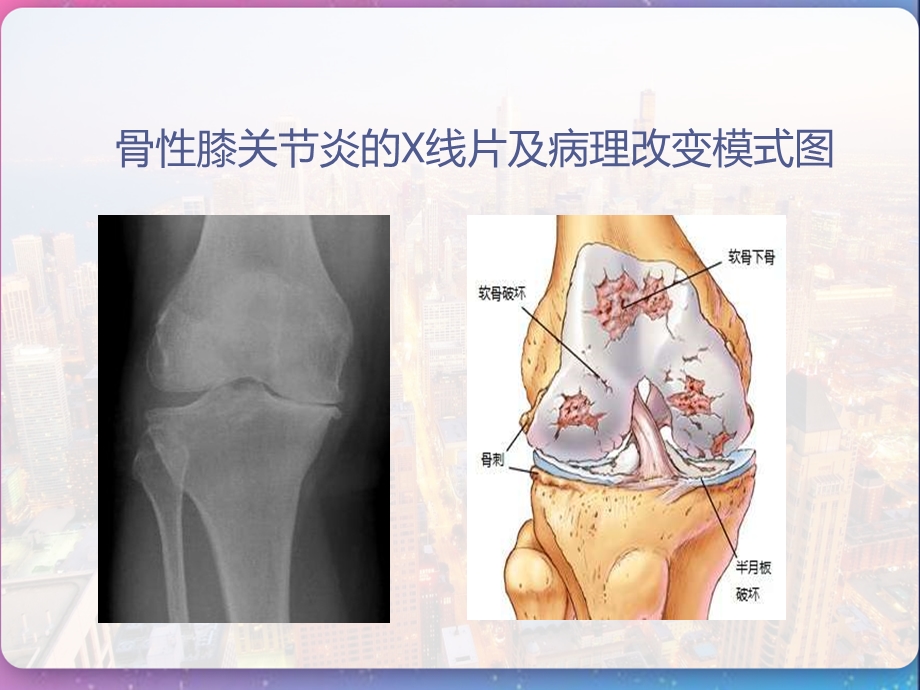 热敏灸治疗骨性膝关节炎课件.pptx_第2页