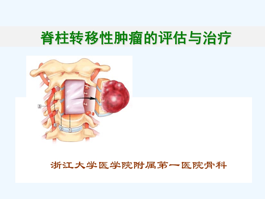 转移性脊柱肿瘤的评估与治疗课件.ppt_第1页