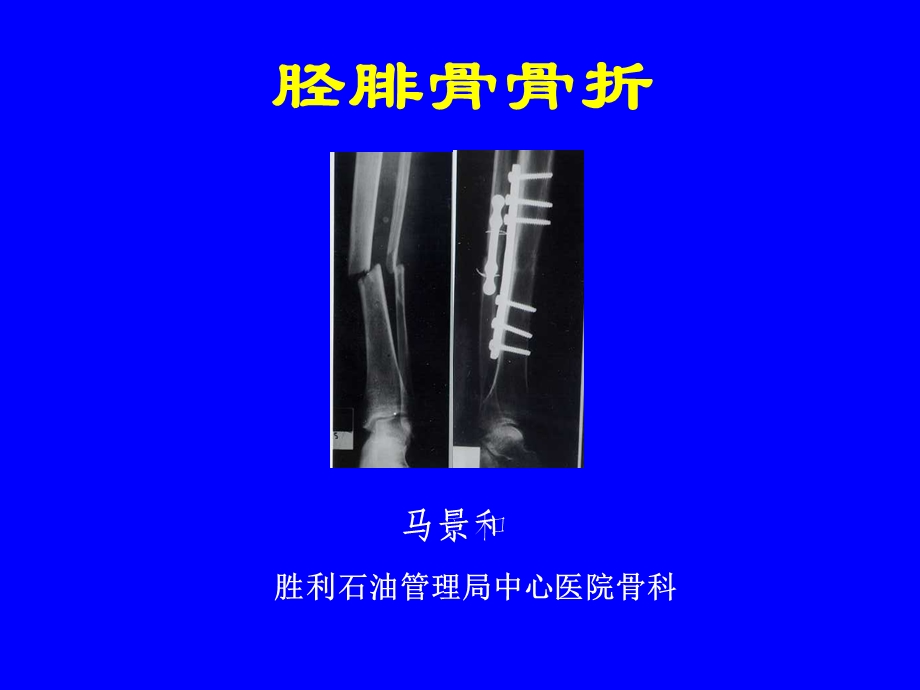 外科学多媒体ppt课件 胫腓骨骨折.ppt_第1页