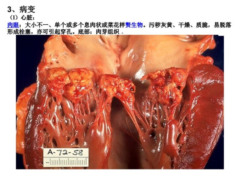 感染性心内膜炎-课件.ppt_第3页