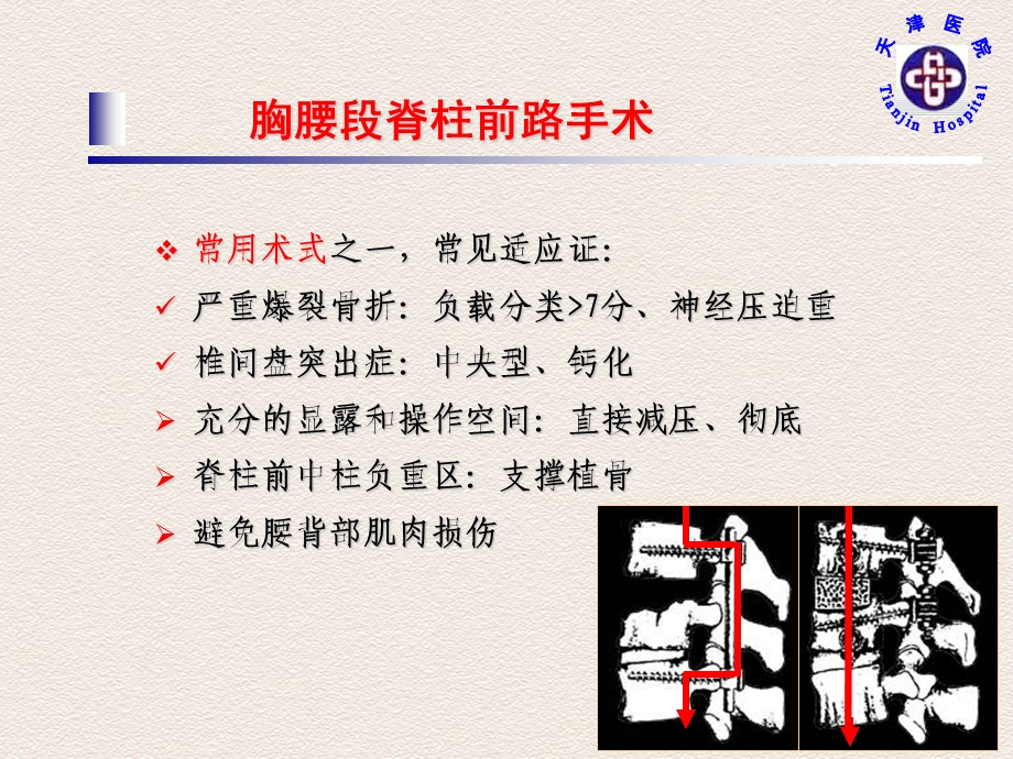 小切口经肋膈隐窝外腹膜后入路在胸腰段脊柱手术中的应用课件.ppt_第3页