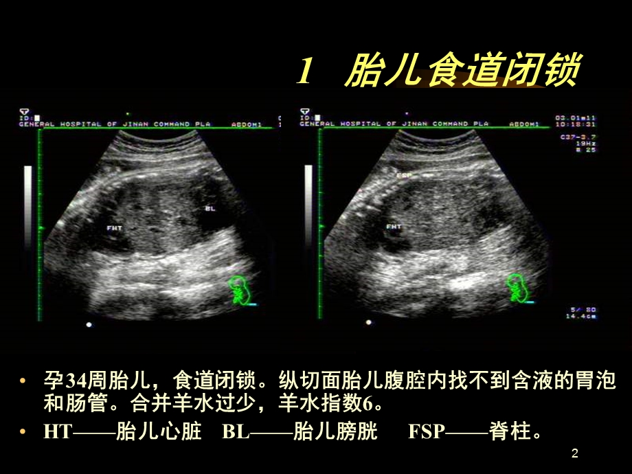 胎儿腹部异常课件.ppt_第2页