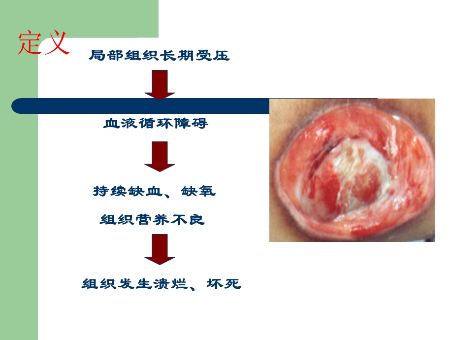 压疮护理及分级课件.ppt_第3页