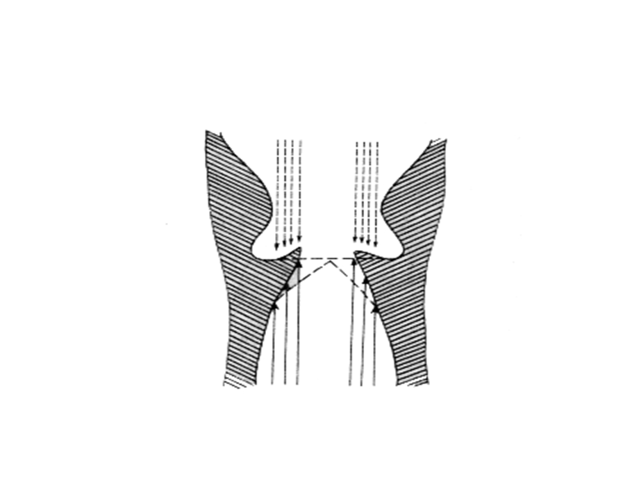 耳鼻咽喉科学英文版ppt课件 laryngeal obstruction.ppt_第3页