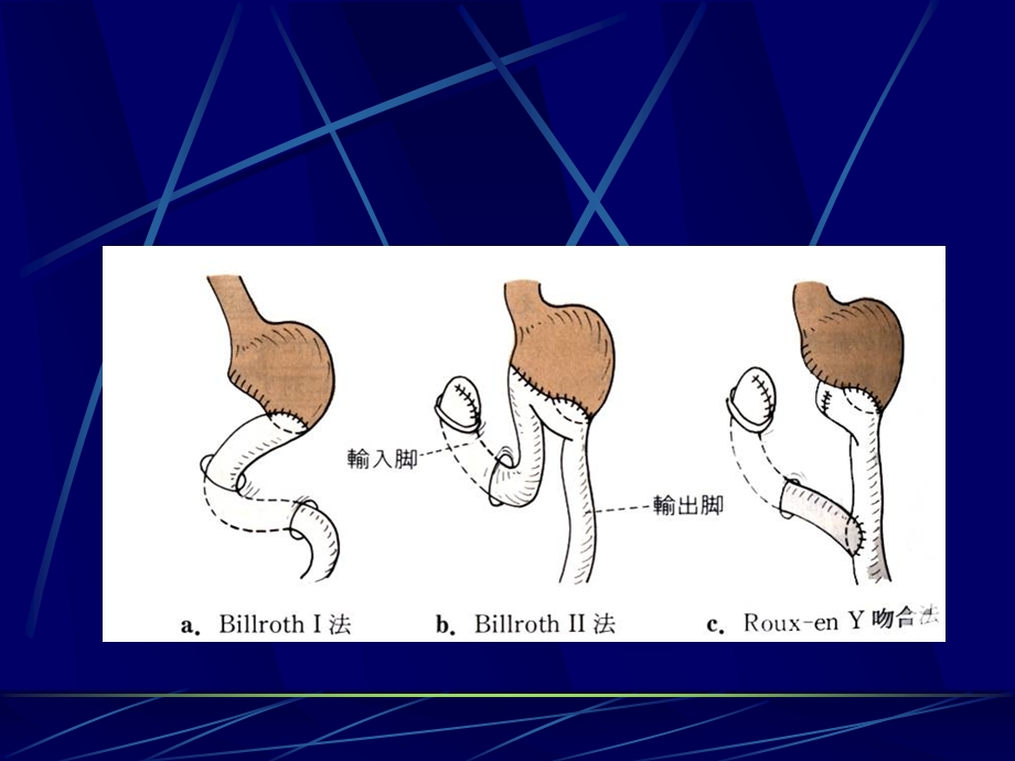 胃术后并发症的观察与护理课件.ppt_第2页