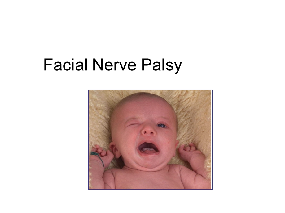 耳鼻咽喉科学英文版ppt课件 facial nerve palsy.ppt_第1页