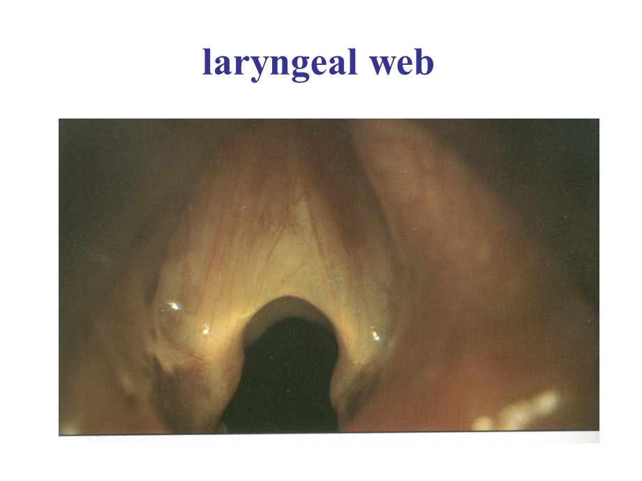 耳鼻咽喉科学英文版ppt课件 congenital lesions of larynx.ppt_第2页