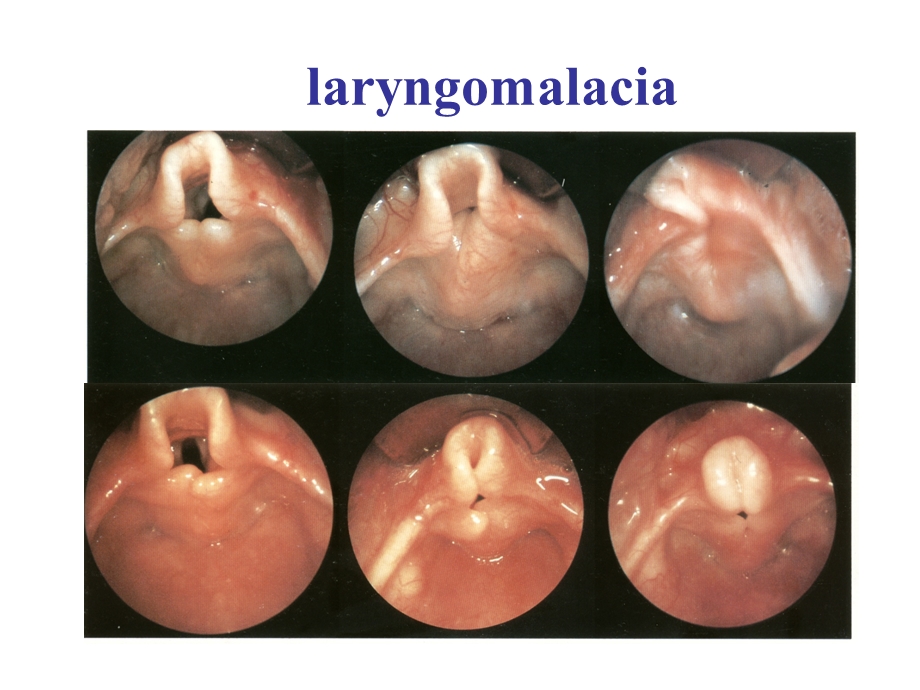 耳鼻咽喉科学英文版ppt课件 congenital lesions of larynx.ppt_第3页