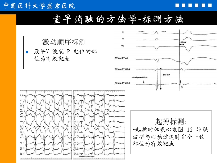 室性早搏消融治疗的适应症、方法学与争议课件.ppt_第3页