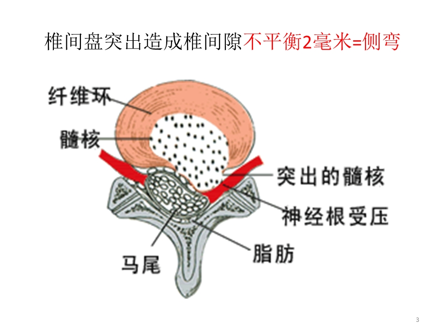 腰椎侧弯体征发生机制与治疗 课件.pptx_第3页