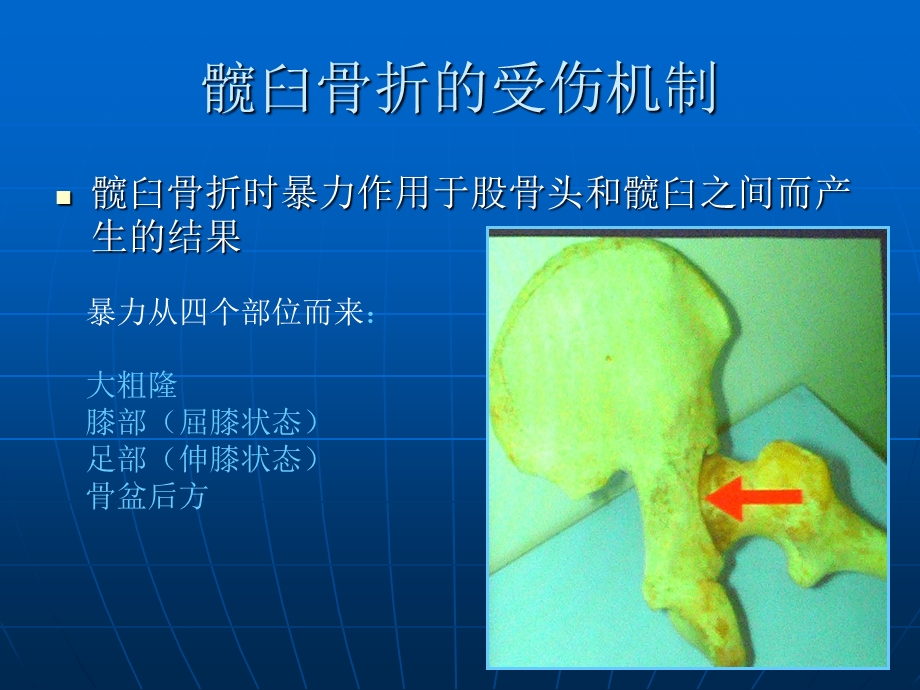 复杂髋臼骨折合并股骨颈骨折手术治疗课件.ppt_第2页