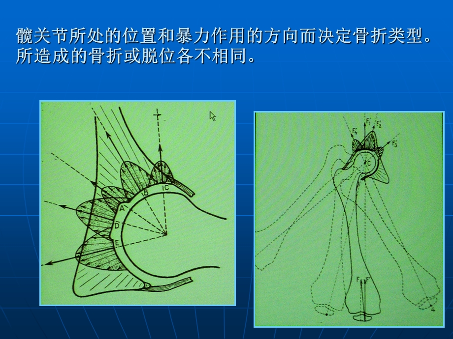 复杂髋臼骨折合并股骨颈骨折手术治疗课件.ppt_第3页