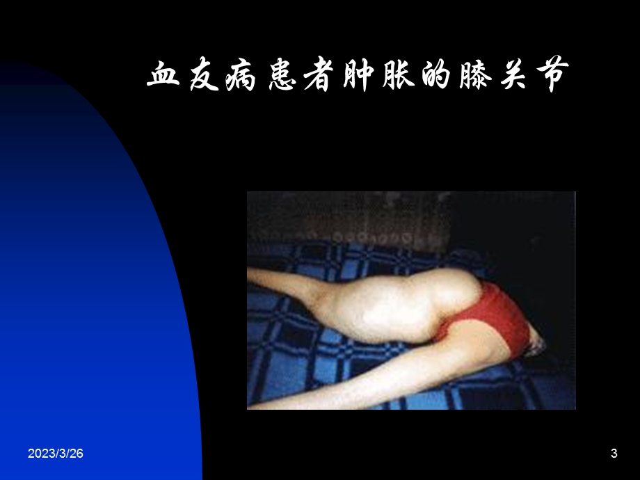 血血栓与止血检测课件.ppt_第3页