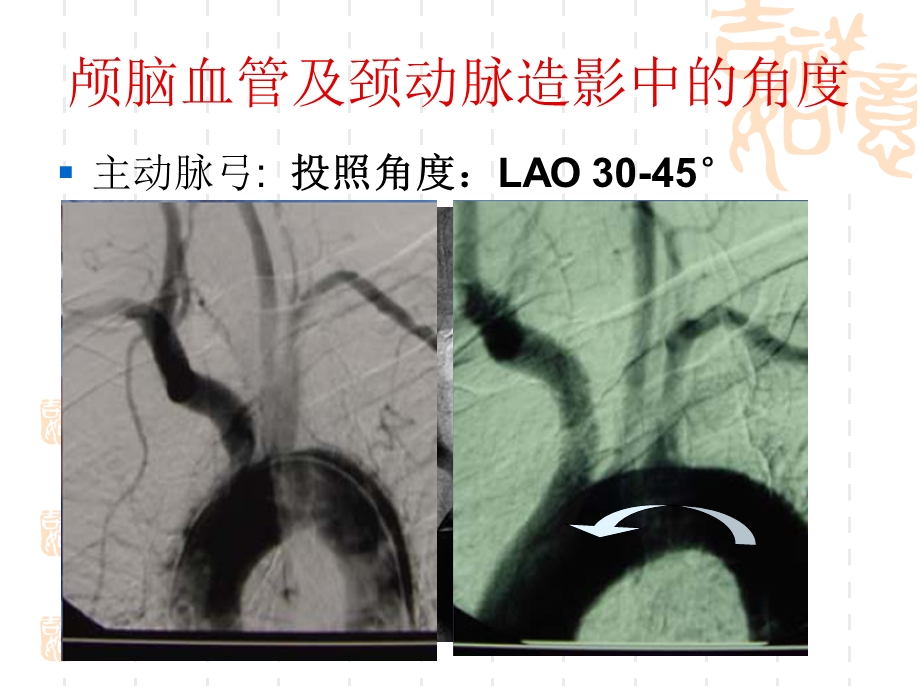 脑血管造影的体位 课件.ppt_第2页