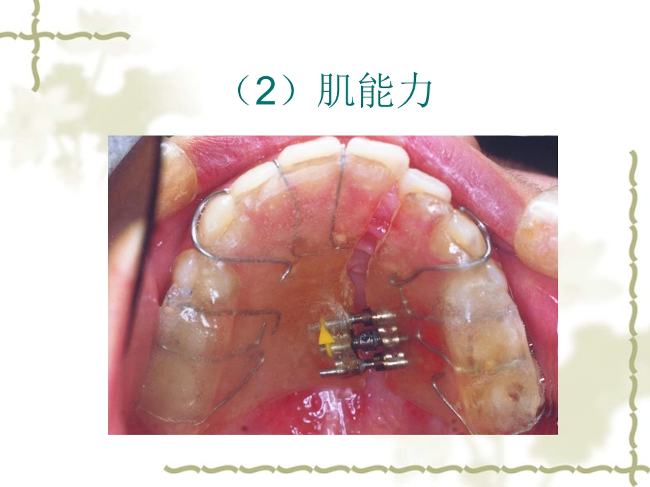 口腔正畸学 正畸治疗的生物机械原理课件.pptx_第3页