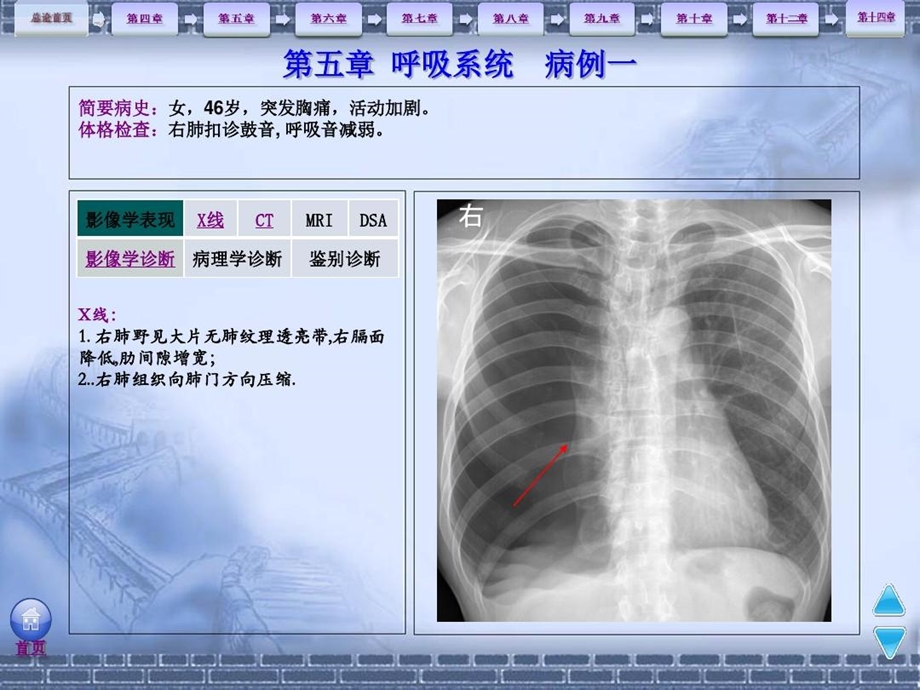 《影像学》病例分析呼吸系统解读课件.ppt_第2页